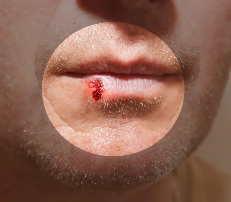 bouton fièvre lèvre virus herpès
