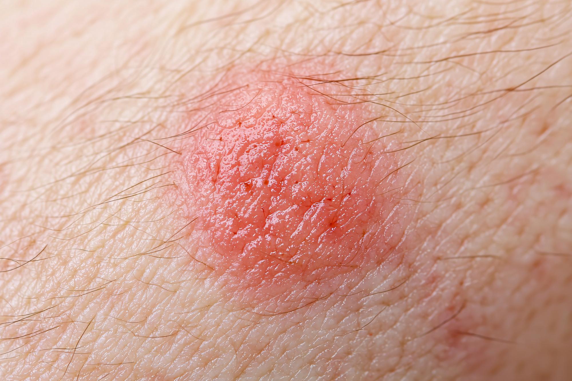 Quelles sont les causes principales d'une auréole rouge sur la peau ?