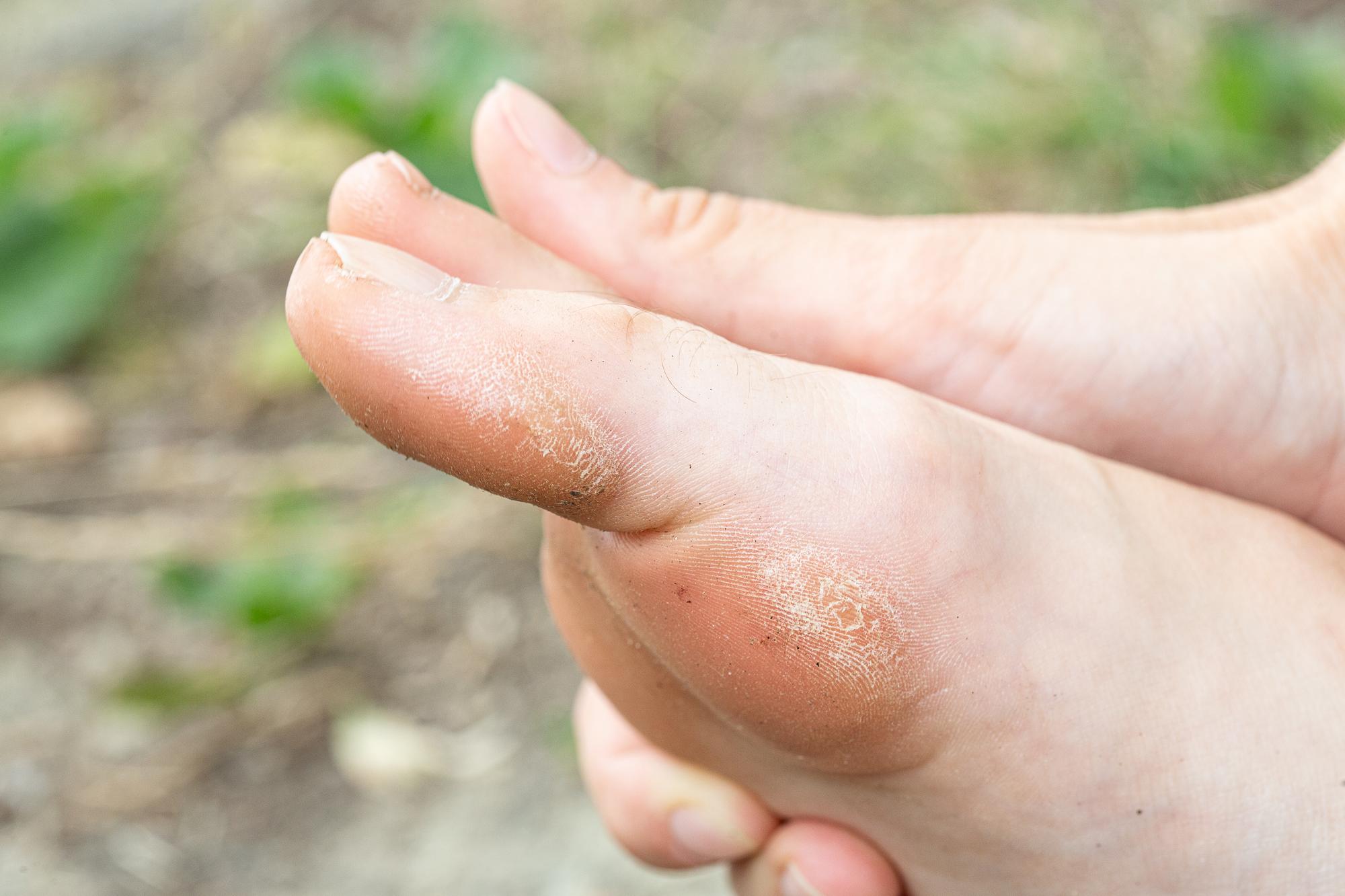 Les mycoses cutanées : tout ce qu'il faut retenir