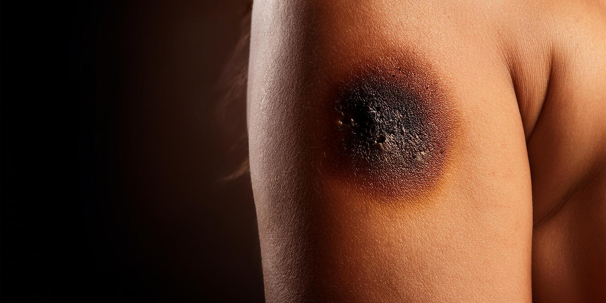 Signes d'alerte : quand une verrue noire ou changeante inquiète ?