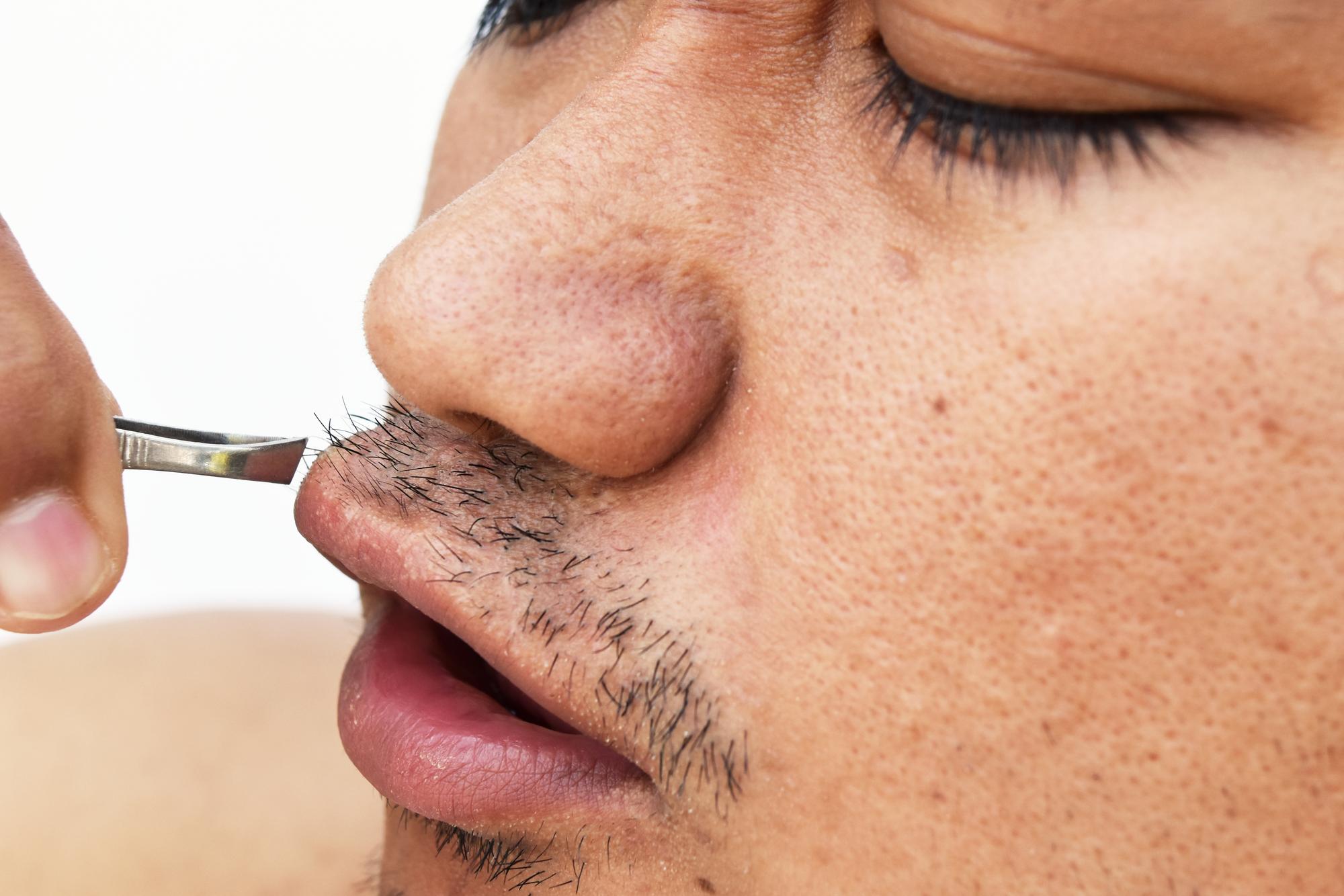 Quelles sont les causes exactes des points noirs autour de la bouche ?