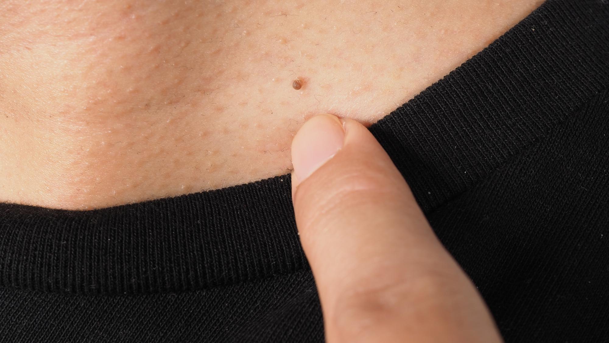 Pourquoi une verrue résiste-t-elle et comment l'affaiblir rapidement ?