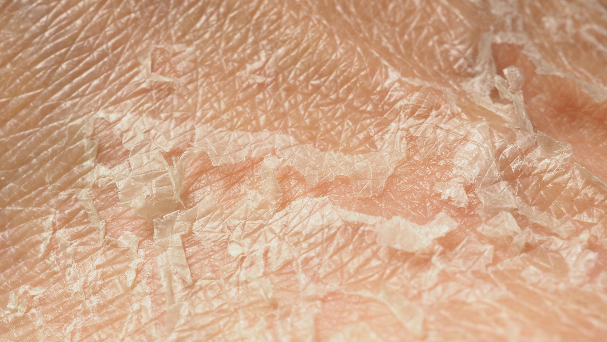 Pourquoi la peau est-elle terne et sèche après les règles ?