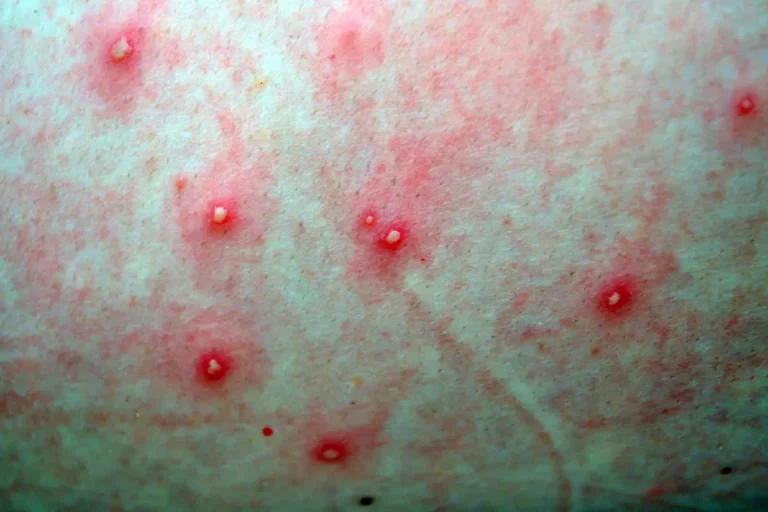 peau irritée boutons rouges corps naturel