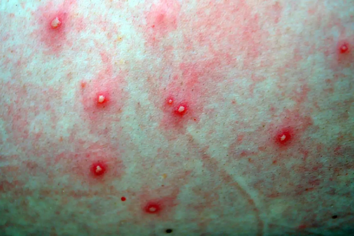 peau irritée boutons rouges corps naturel
