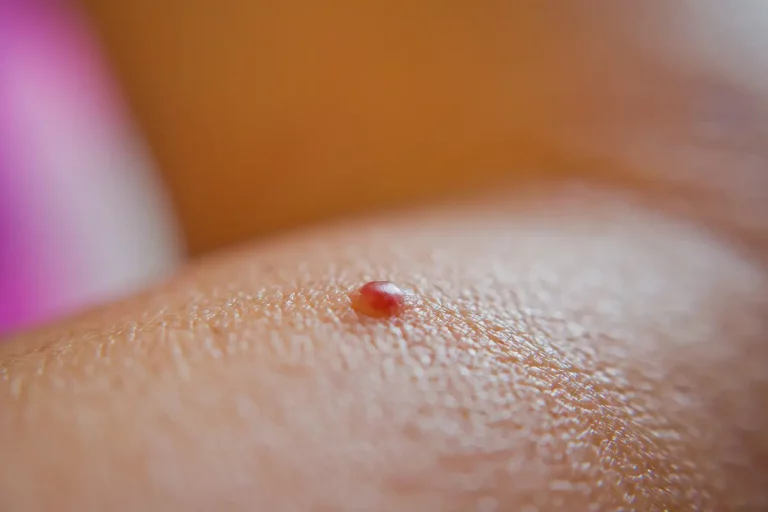 petit bouton rouge peau bras