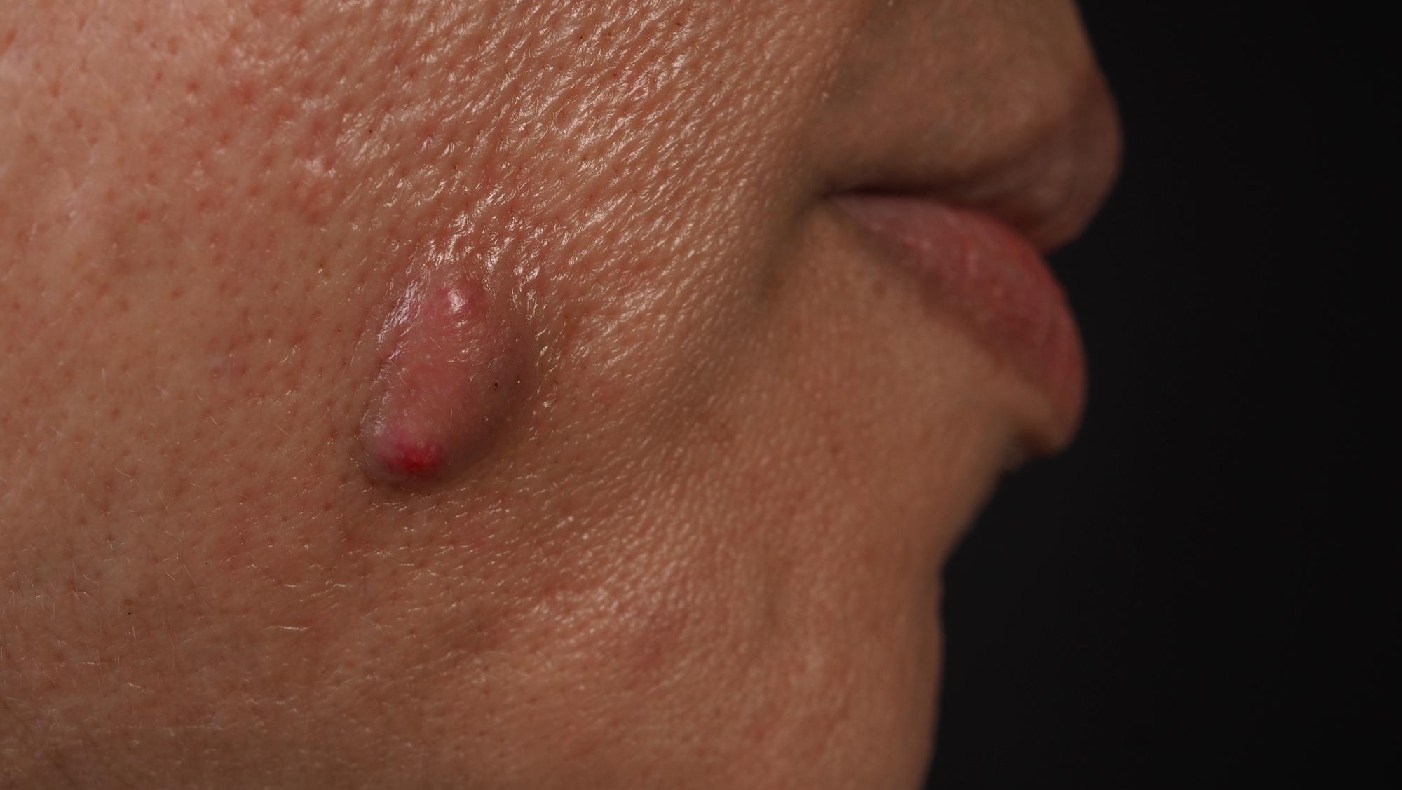 Qu'est-ce qu'un petit bouton rouge non prurigineux exactement ?