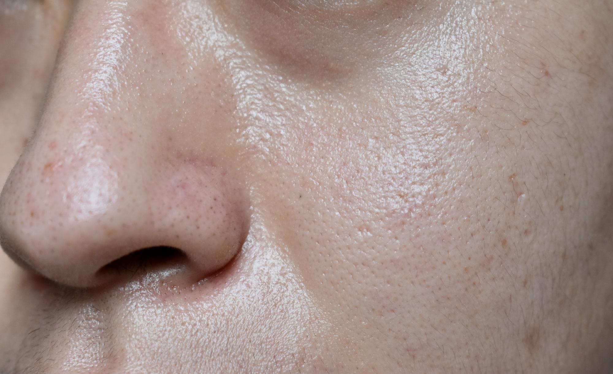 Pourquoi la peau du visage devient-elle rugueuse ?