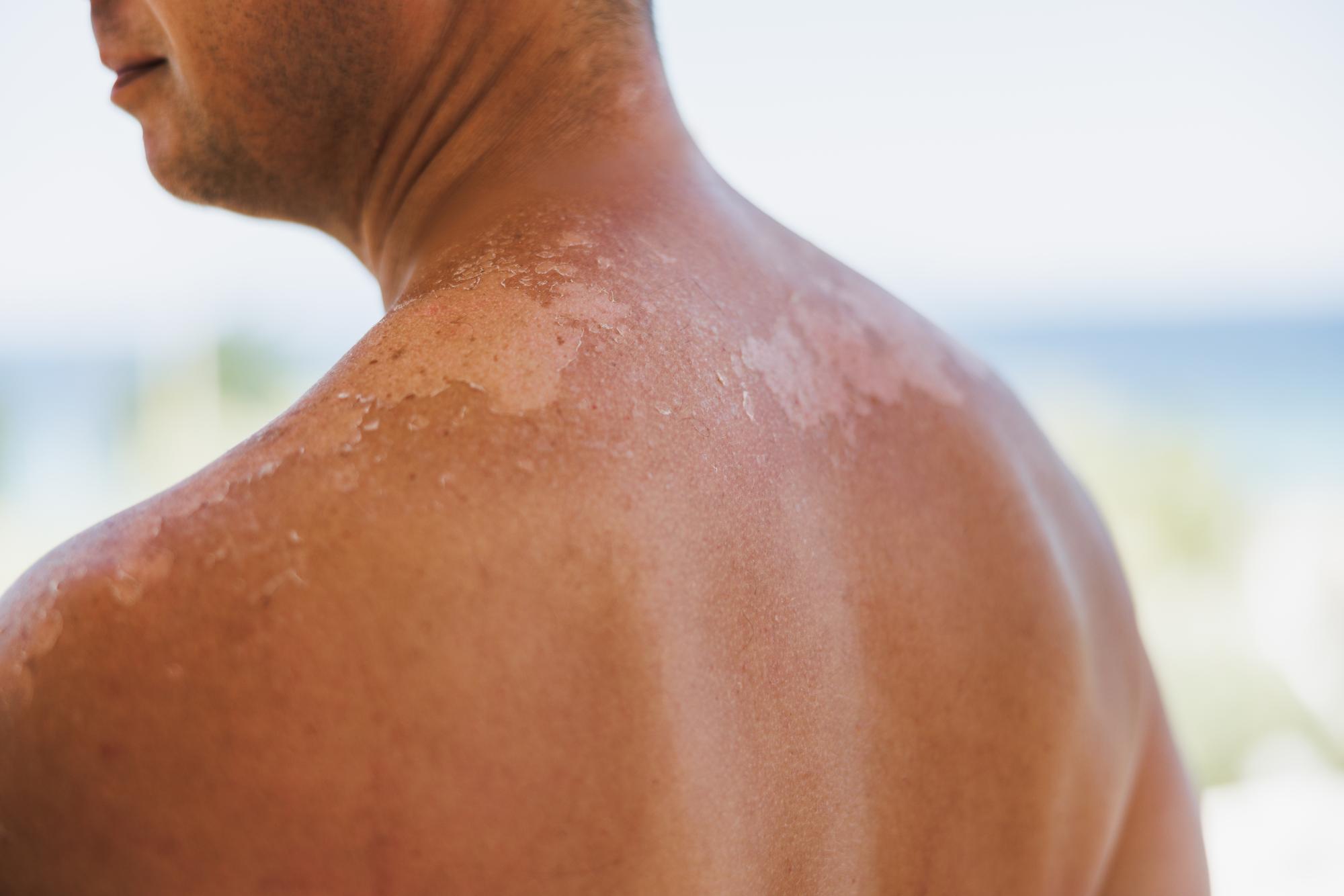 Que se passe-t-il dans la peau lors d’un coup de soleil ?