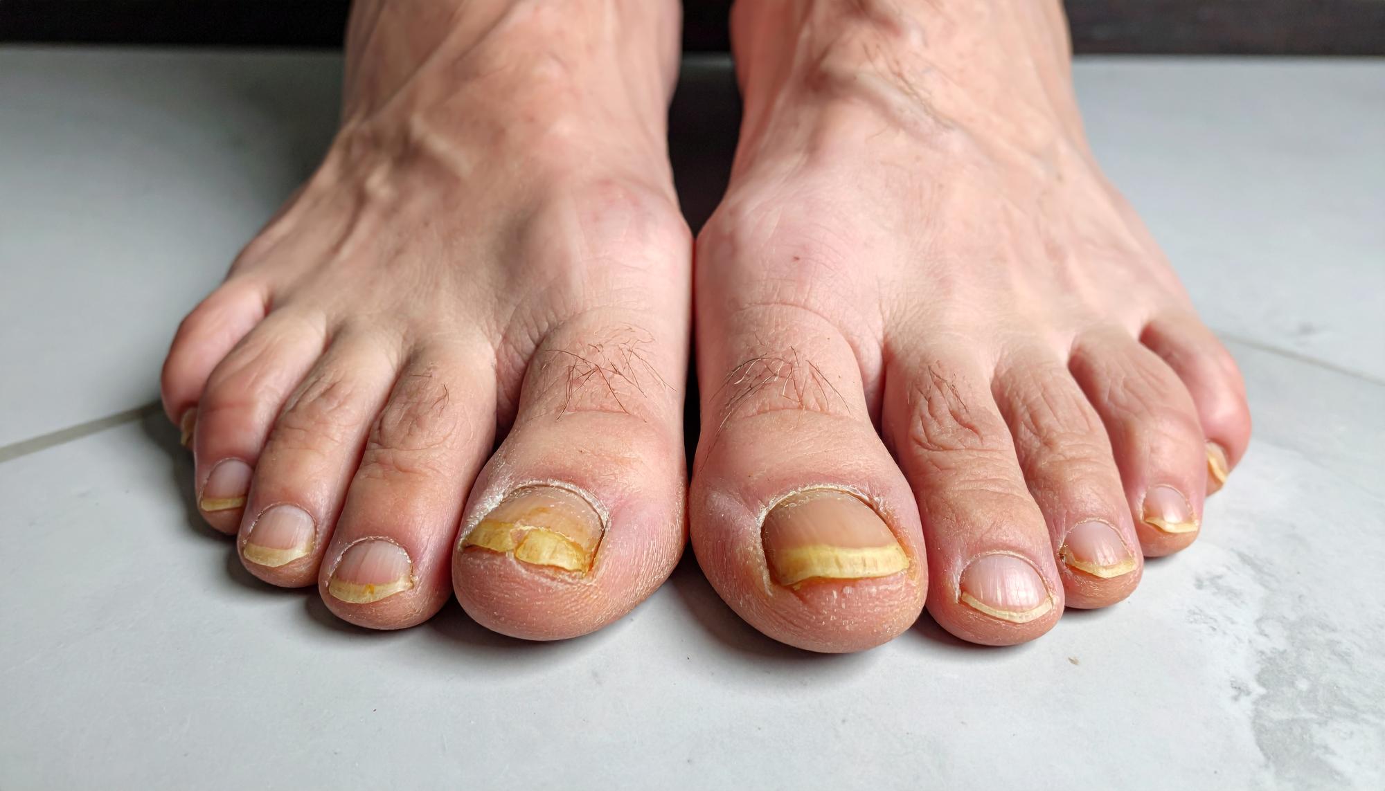 D’où viennent les ongles d’orteils jaunes ?