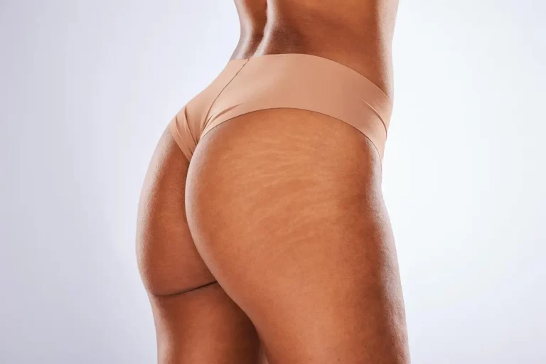 back stretch marks skin