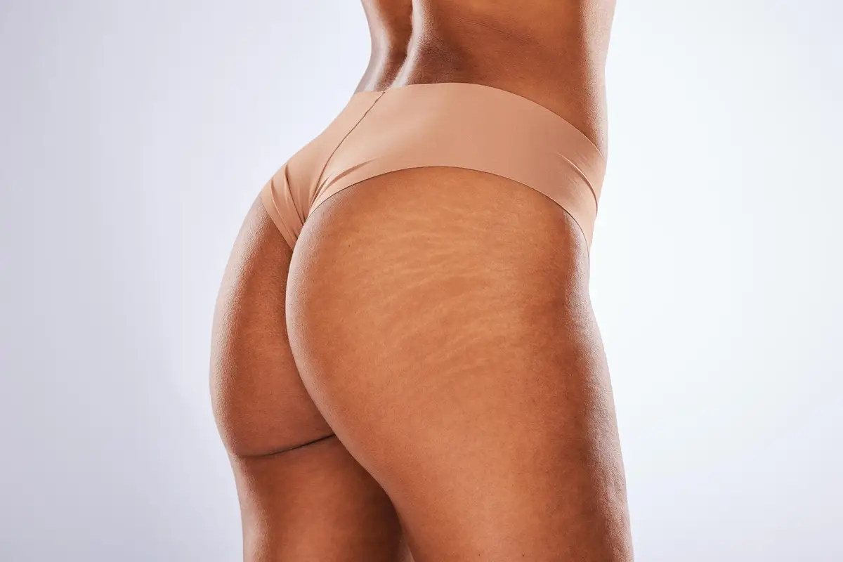 back stretch marks skin