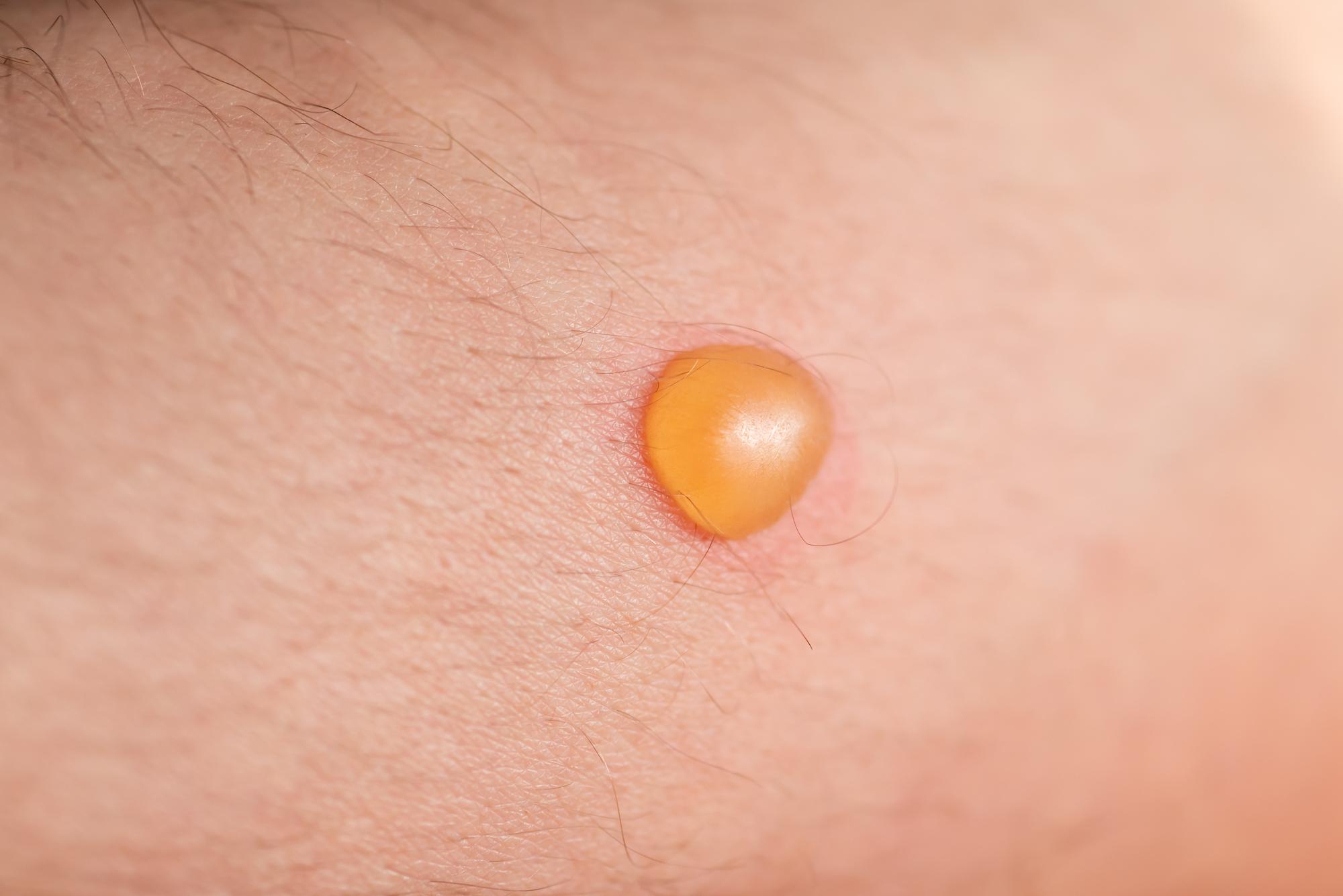 Percer une cloque de brûlure : pourquoi c’est risqué ?