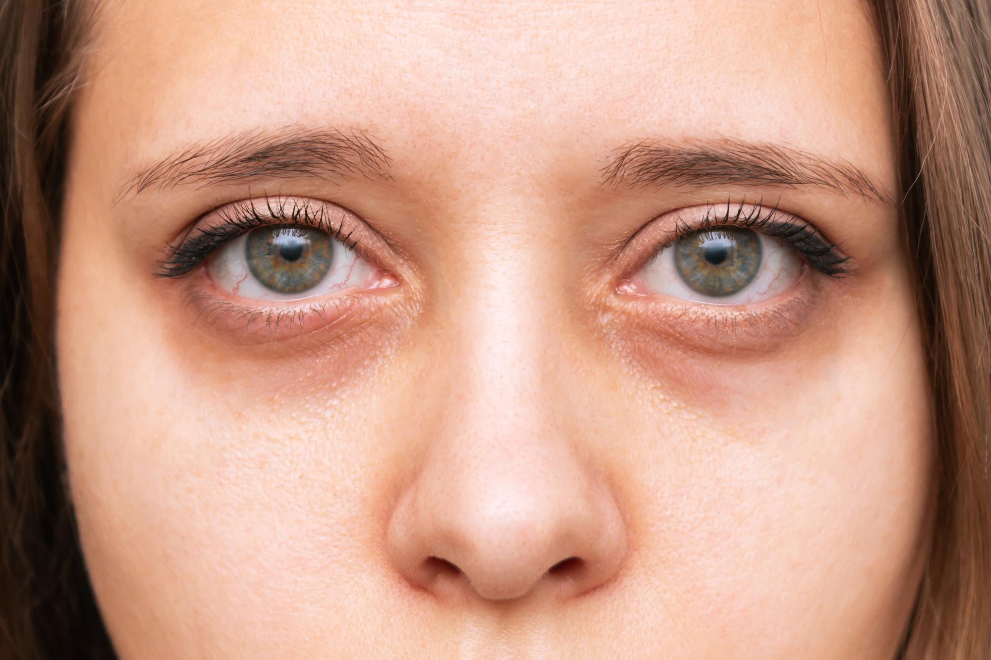 Gonflement sous les yeux ou cernes : comment faire la différence ?