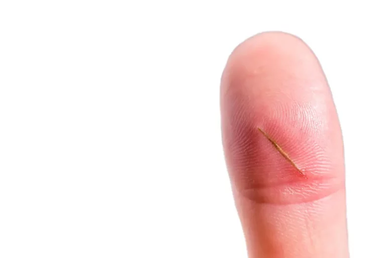 finger splinter