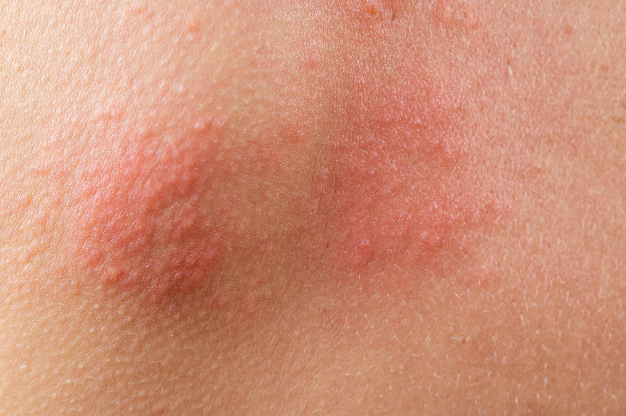 Comment reconnaître une peau sensible ?
