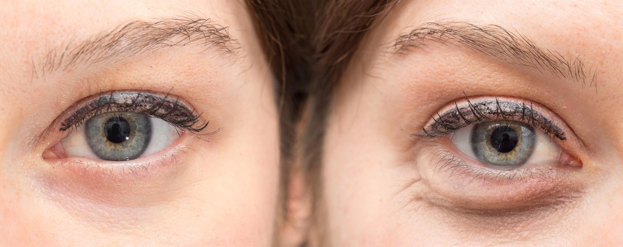 Quelles sont les principales causes de gonflement sous les yeux ?