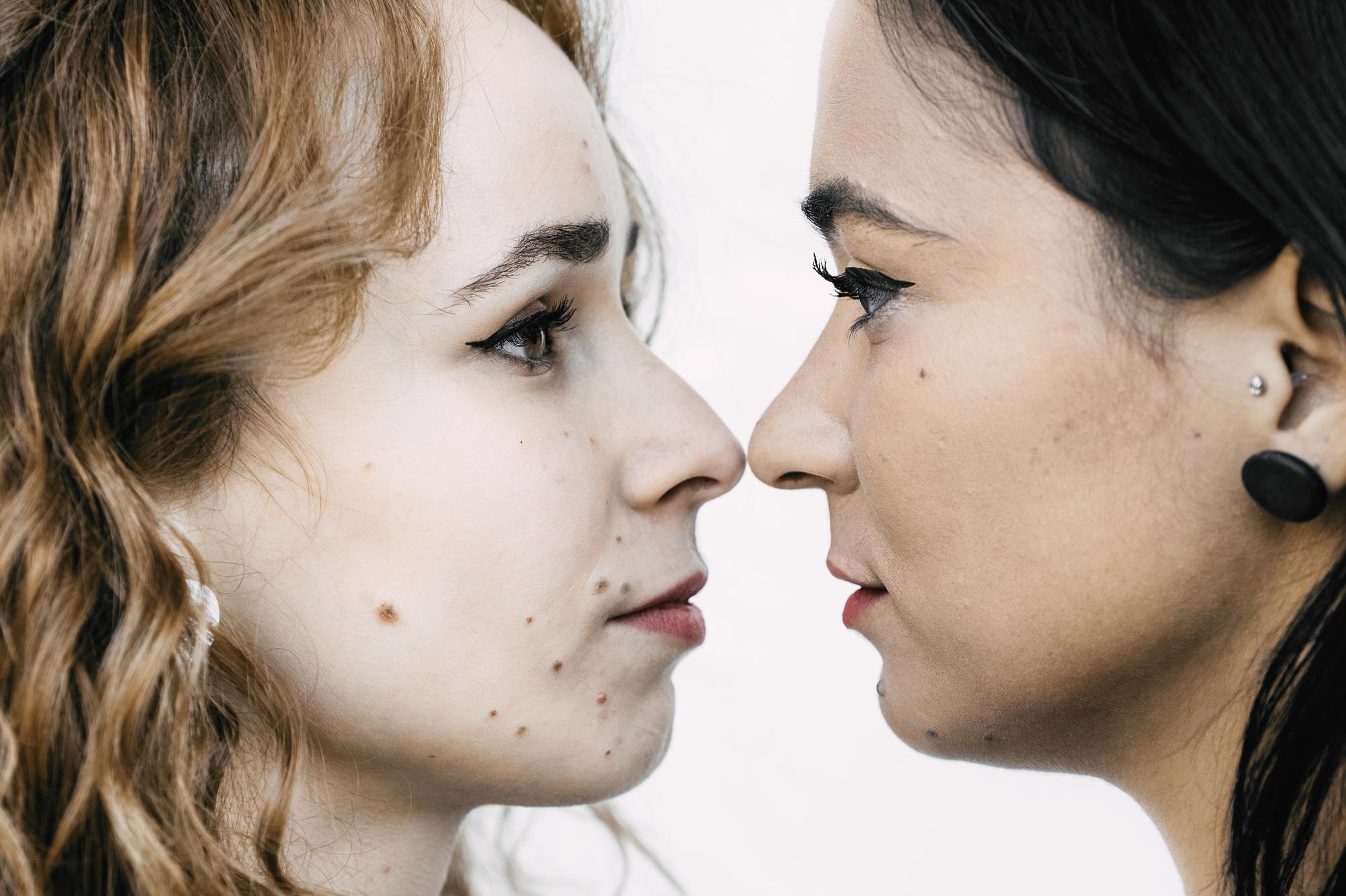 Le bon réflexe si vous hésitez entre tache de rousseur et mélanome