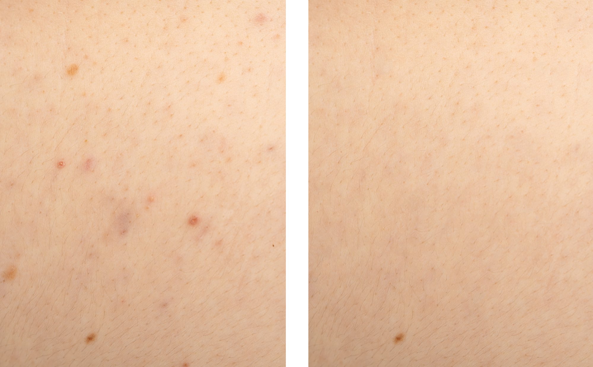 Liens entre boutons sur les fesses, comédons et boutons hormonaux