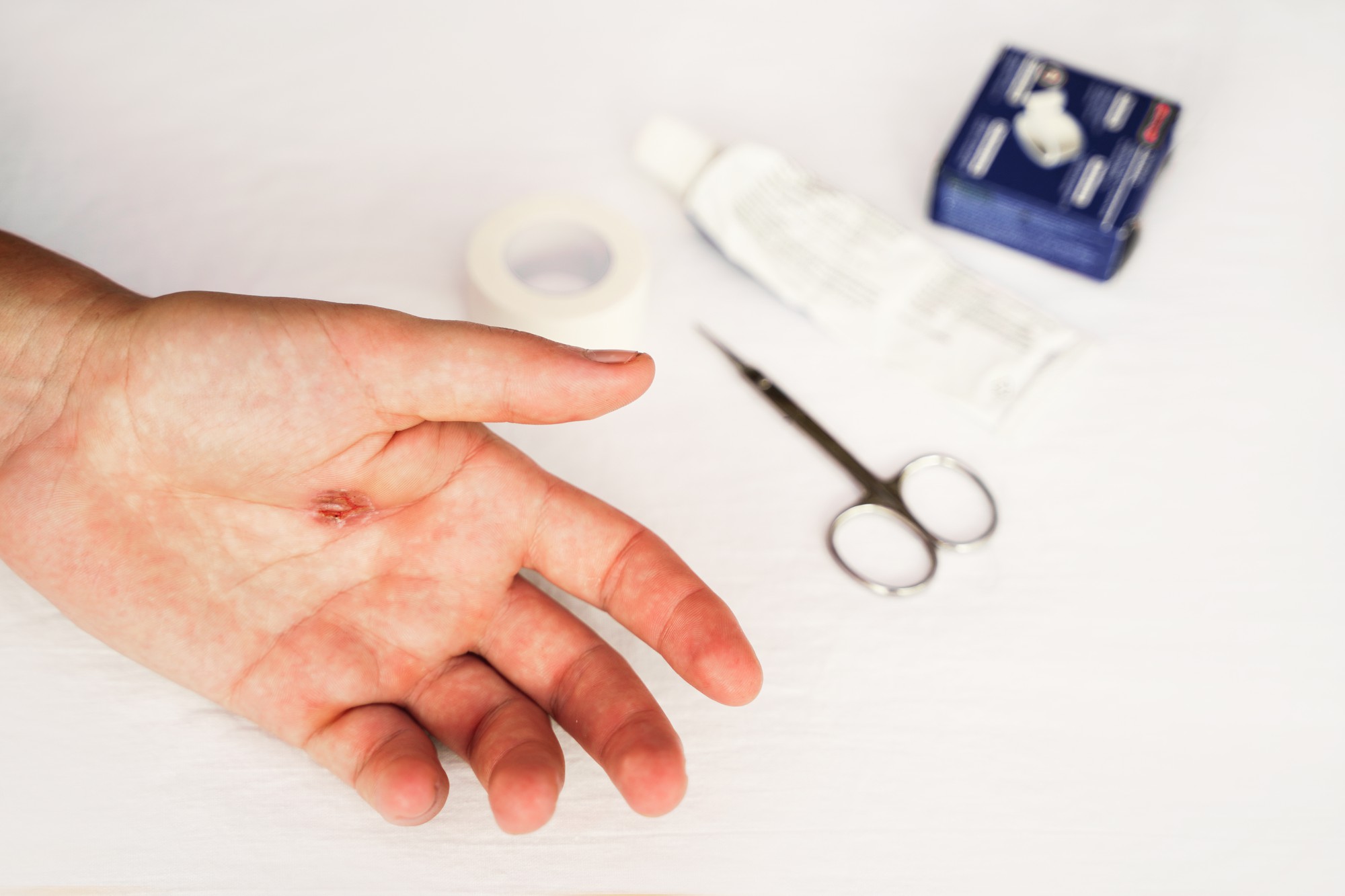 Comment soigner une cloque de brûlure pour éviter que la main pèle mal ?