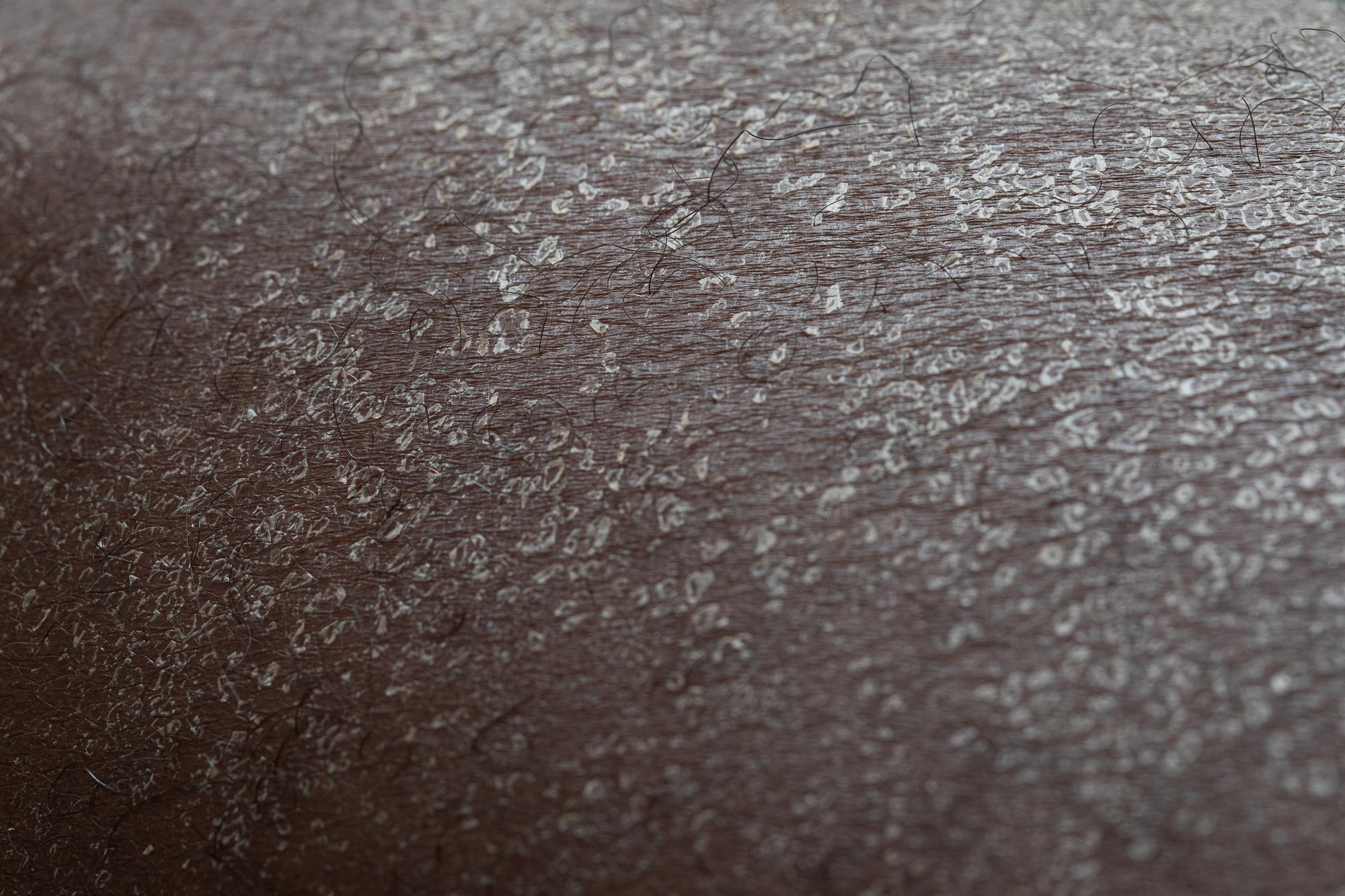 Comment reconnaître une peau très sèche plutôt qu’une peau déshydratée ?