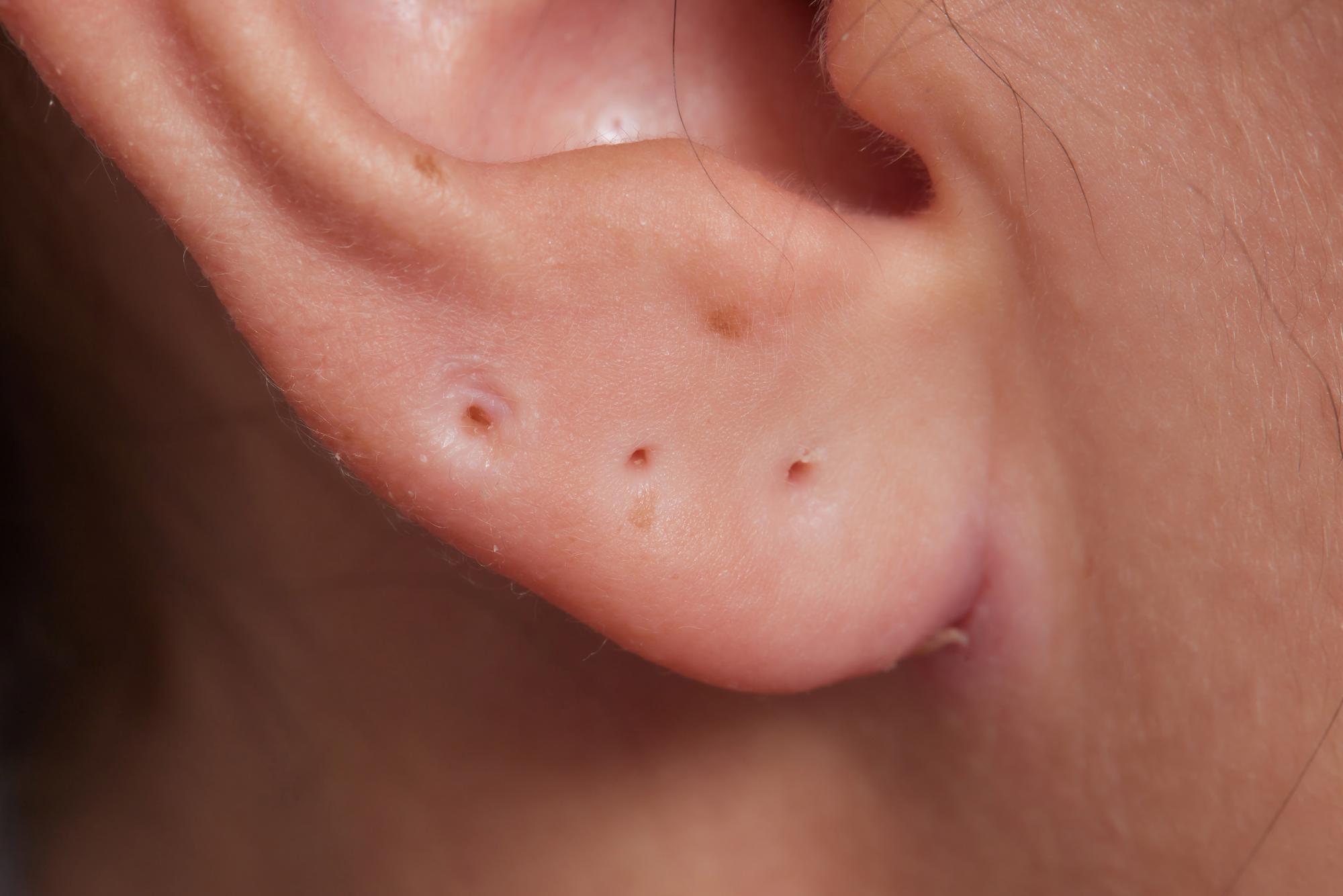 Pourquoi a-t-on un point noir dans l’oreille ?