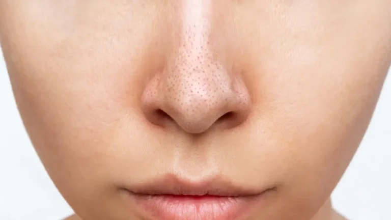 face close-up blackheads