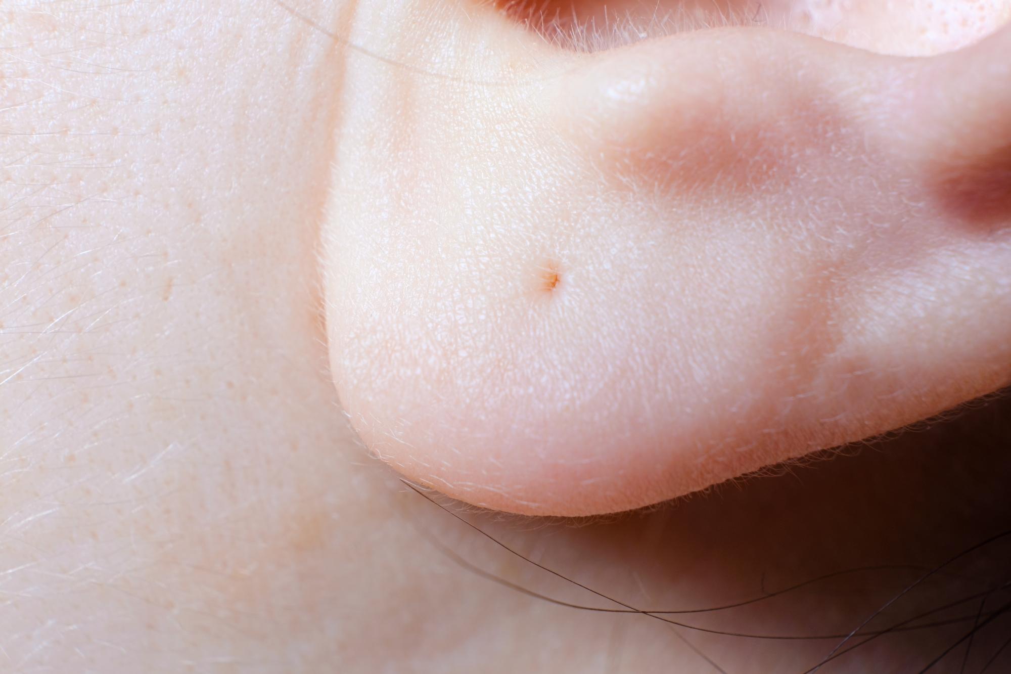 À quoi ressemble une verrue sur le visage ?