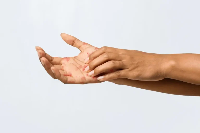 mains peau qui pèle