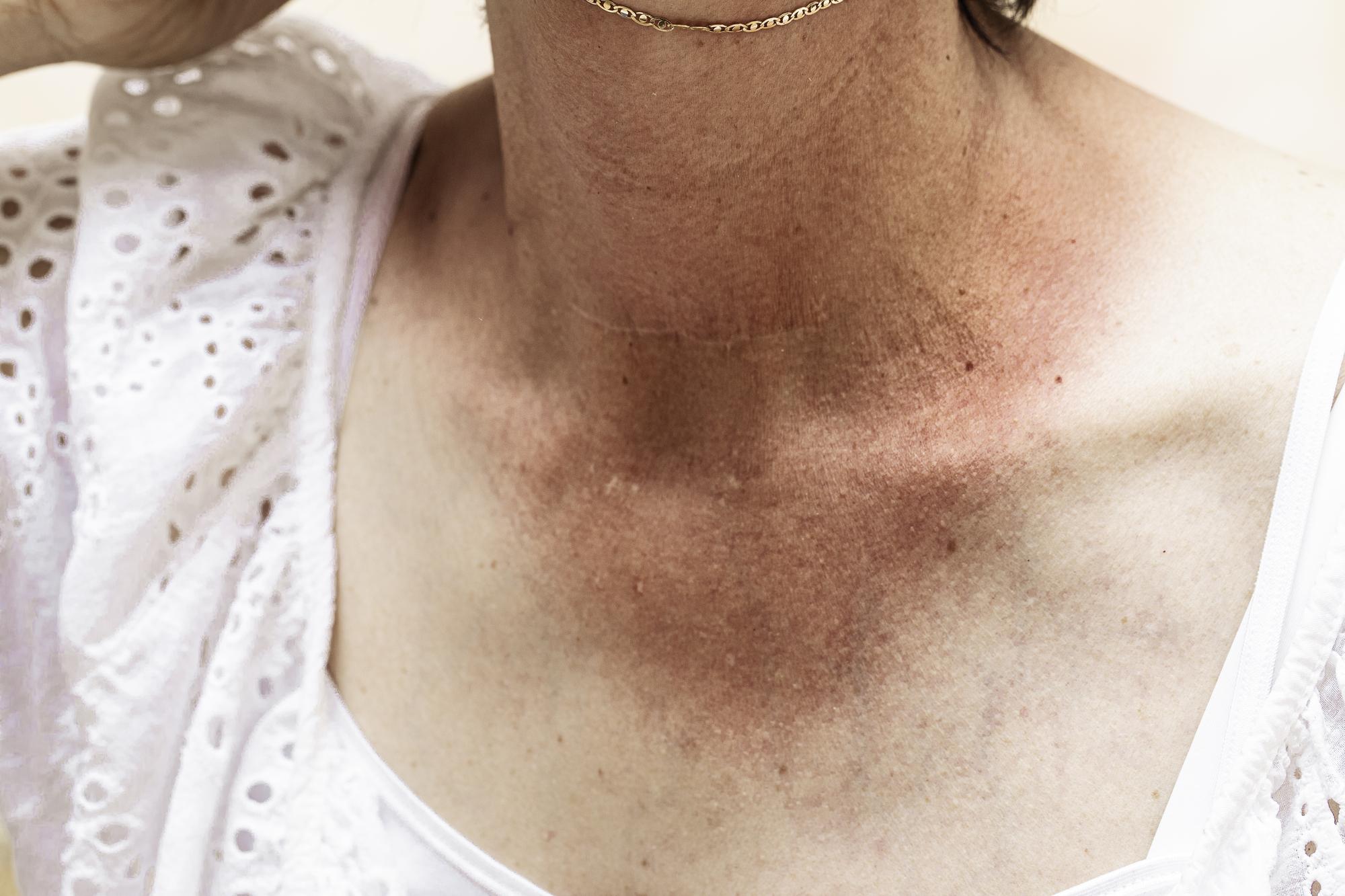 Coup de soleil et huile de coco : bonne idée ou fausse amie ?