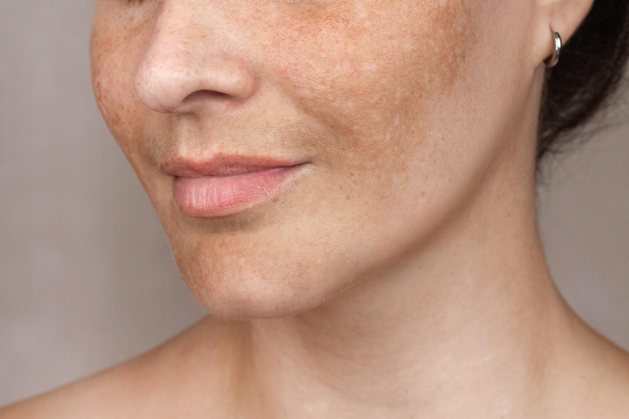 Que faire si la peau présente une dépigmentation ?