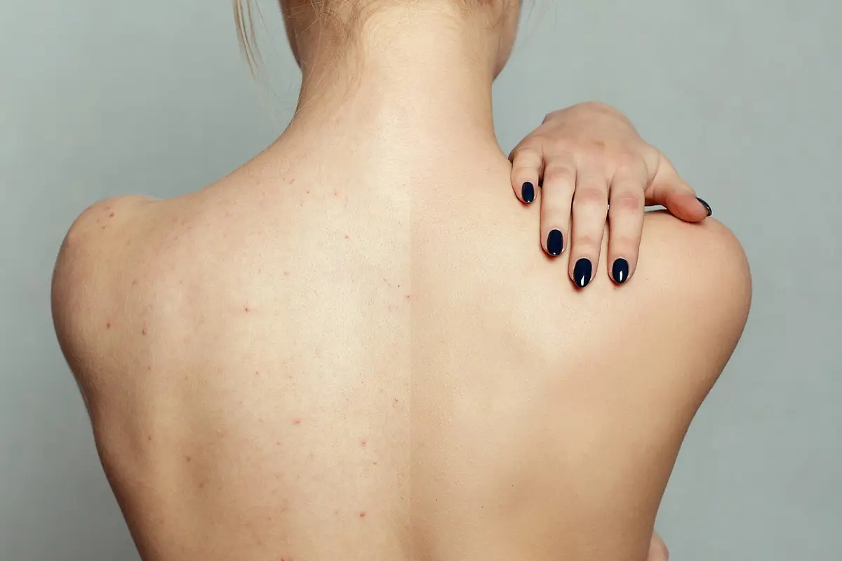 dos peau points noirs