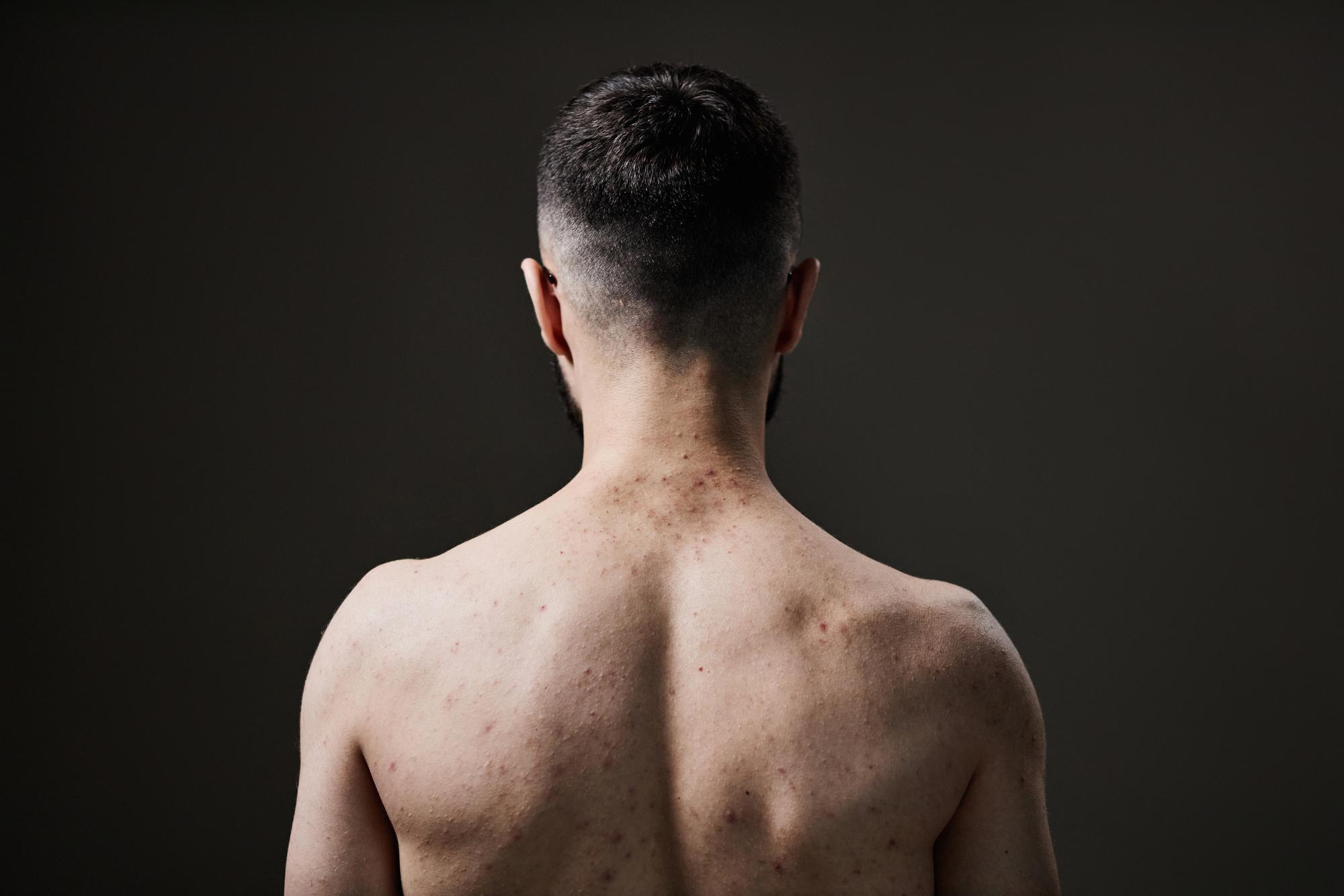 Pourquoi les hommes ont-ils des boutons dans le dos ?